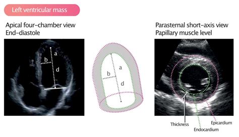 csecho lv mass